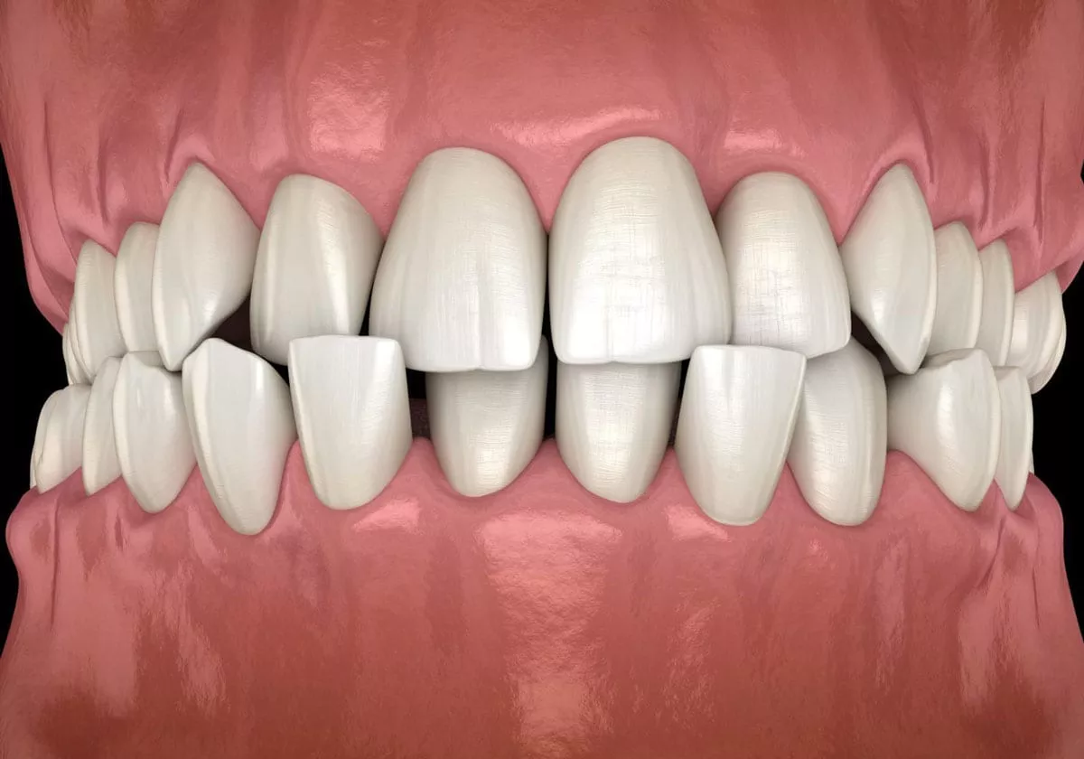 Invisalign for crossbite in Forest Hill