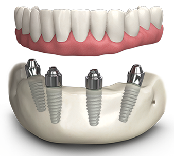 all-on-6-implants in forest hill and dulwich from london dental arts