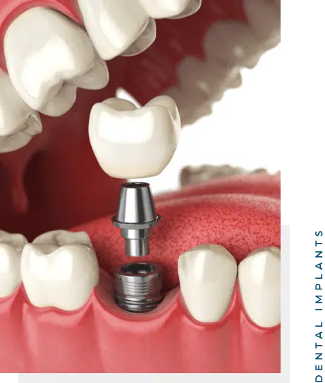 Dental Implants