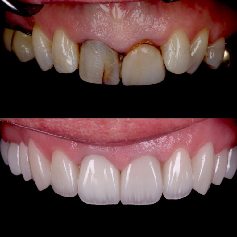 Smile restoration result at London Dental Arts
