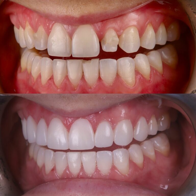 Smile result at London Dental Arts 2