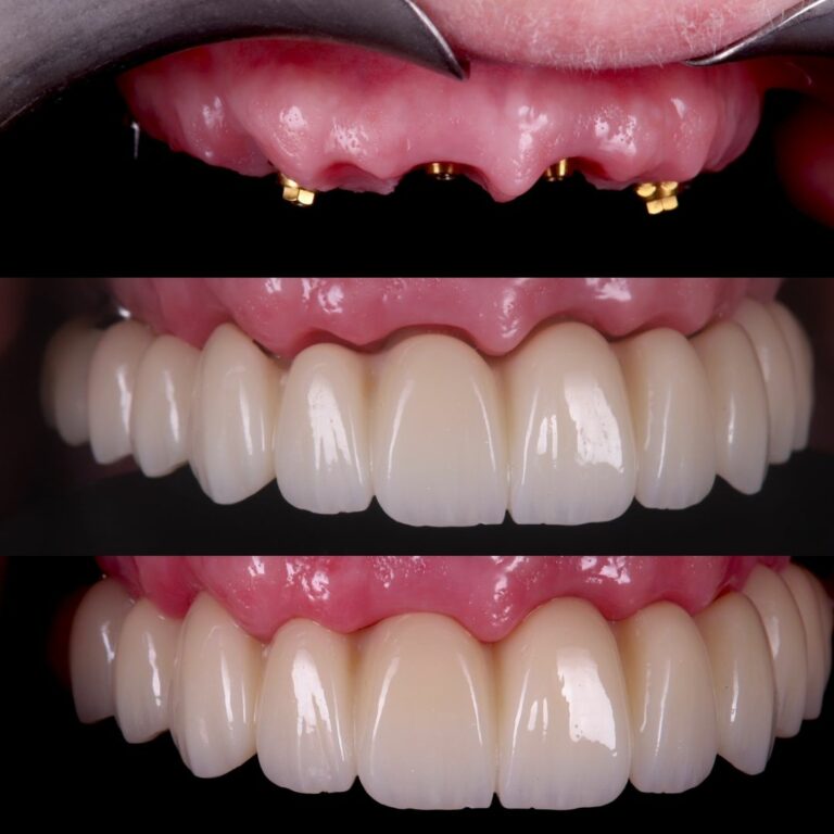 Dental implant before and after result