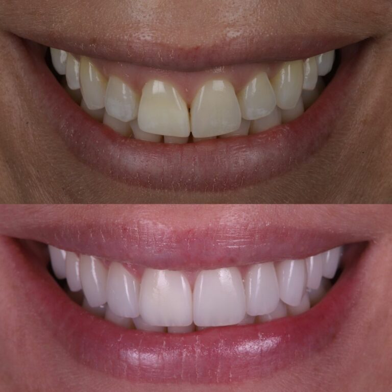Smile result at London Dental Arts 1