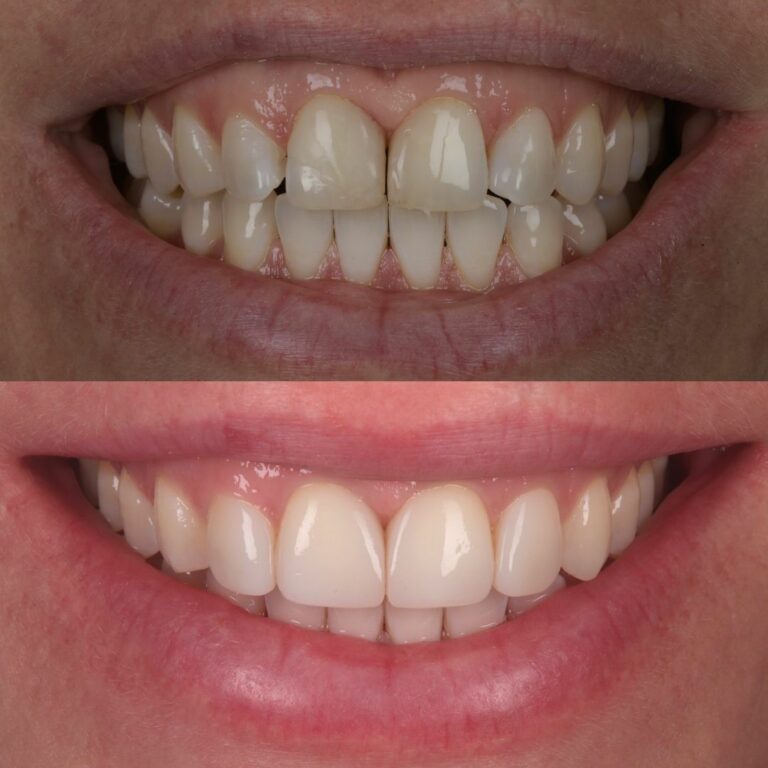 Smile result at London Dental Arts 4