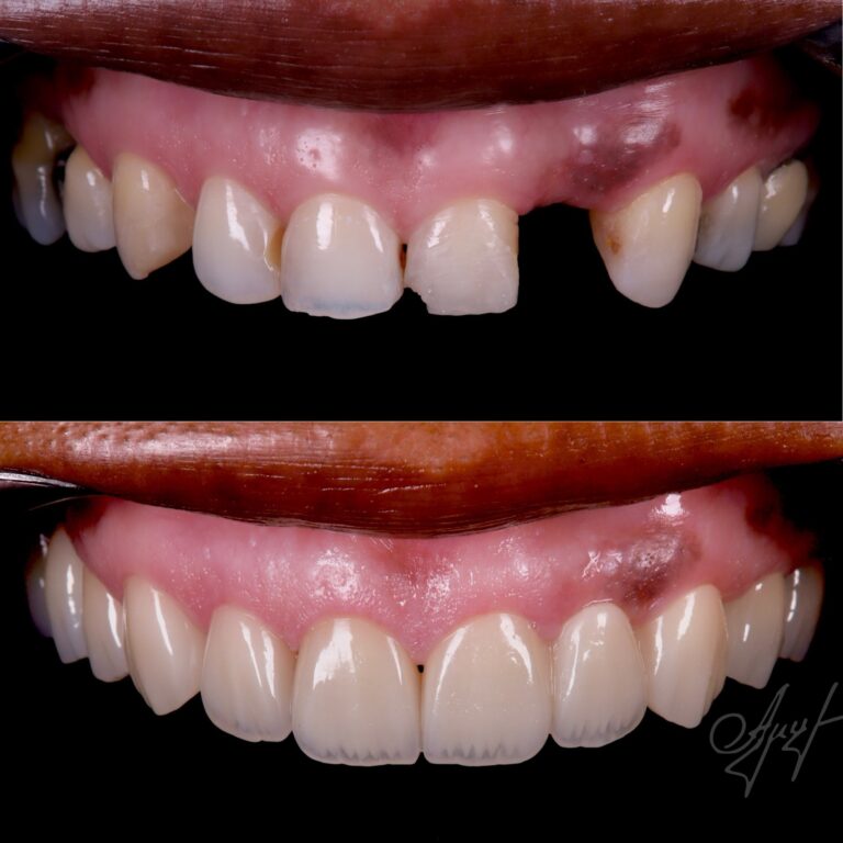 Dental implant smile transformation