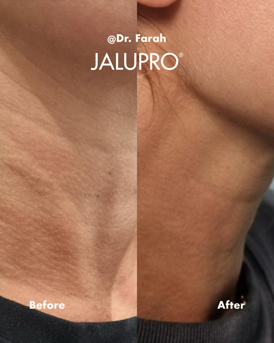 Jalupro skin regeneration facial result before and after
