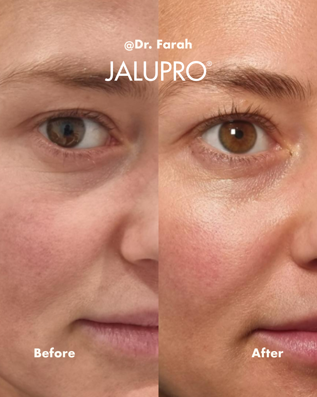 Comprehensive skin regeneration with Jalupro before and after