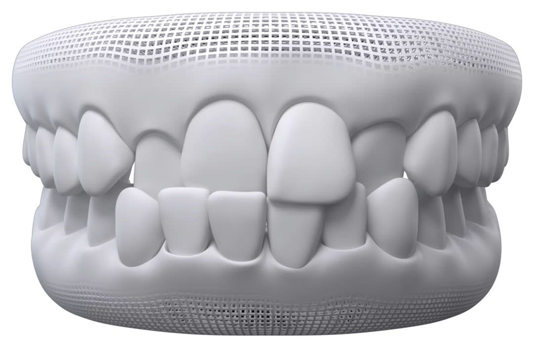 Crossbite teeth alignment concern