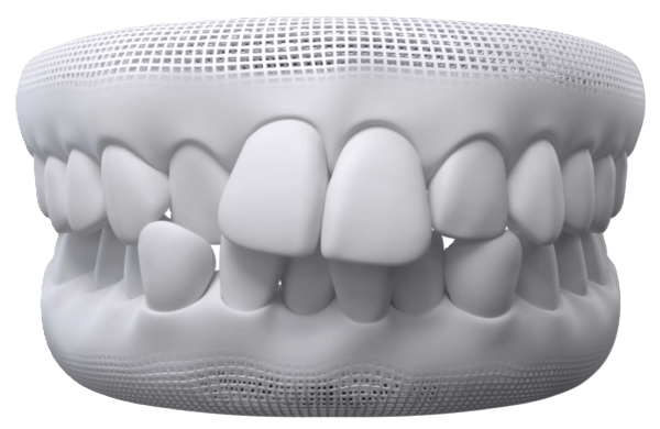 Crowded teeth that may be suitable for Invisalign
