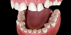 Dental Bruxism