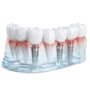 Multiple Teeth Implants Forest Hill