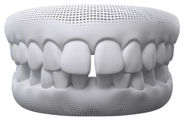 Widely spaced or gapped teeth