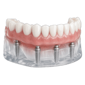 Implant-Support Denture