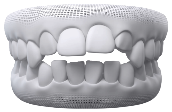 Open bite teeth alignment concern