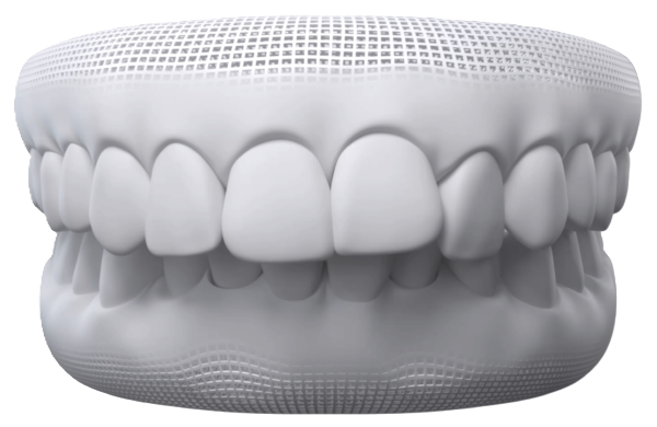 Overbite teeth alignment concern