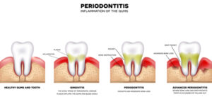 Periodontist Forest Hill