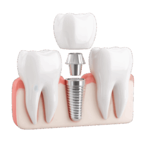 Single Tooth Implant Forest Hill