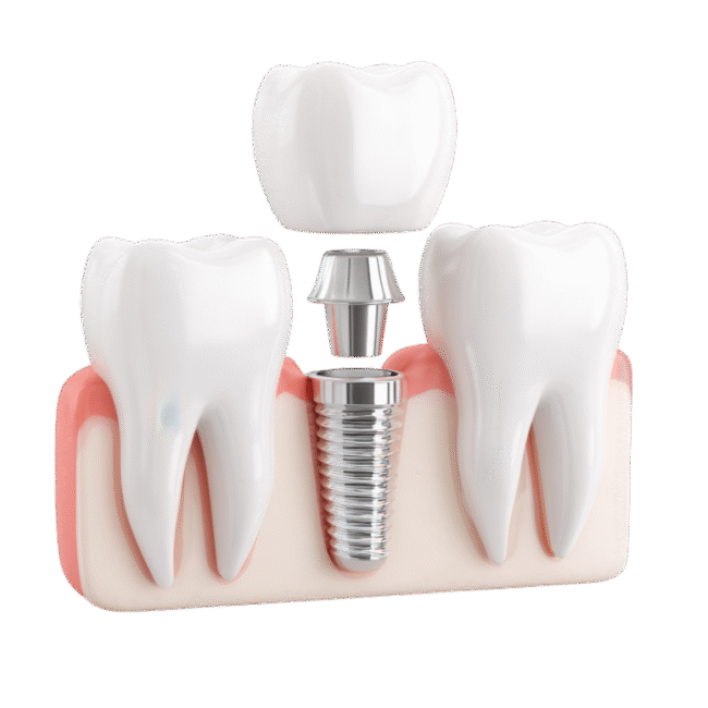 Single Tooth Implant Forest Hill