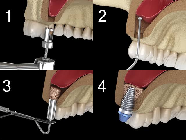 Sinus Lift Before Dental Implants