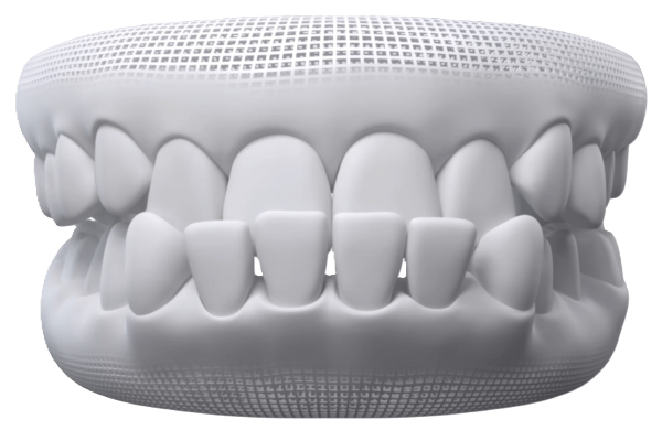Underbite teeth alignment concern