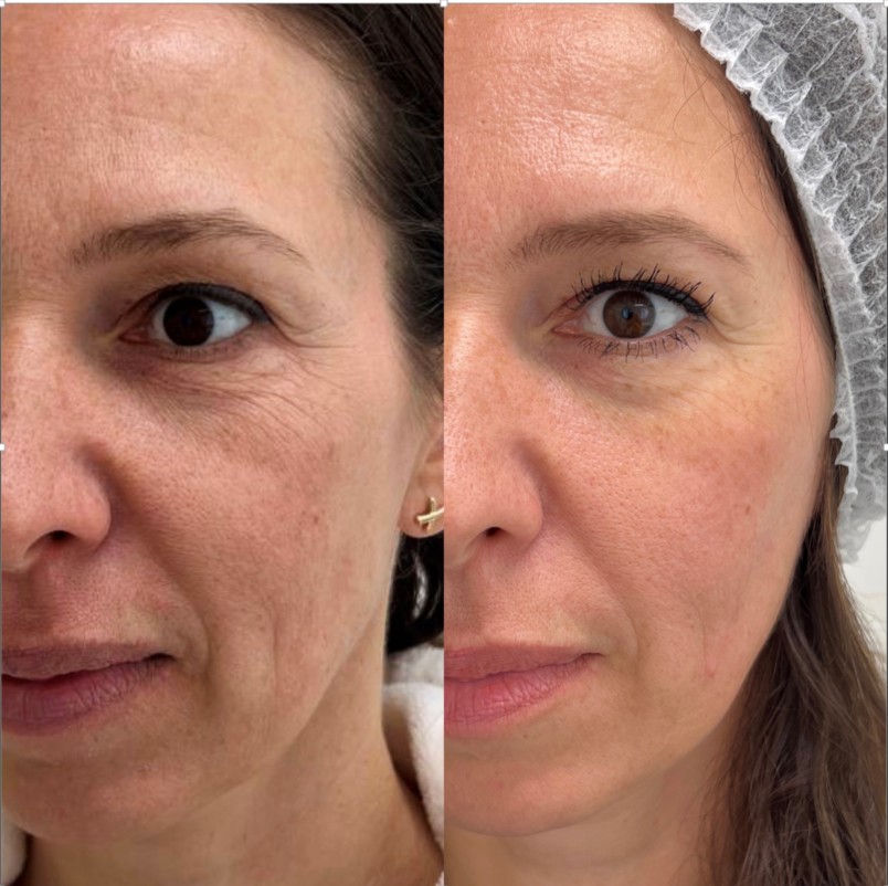 Jalupro Young Eye under eye treatment before and after