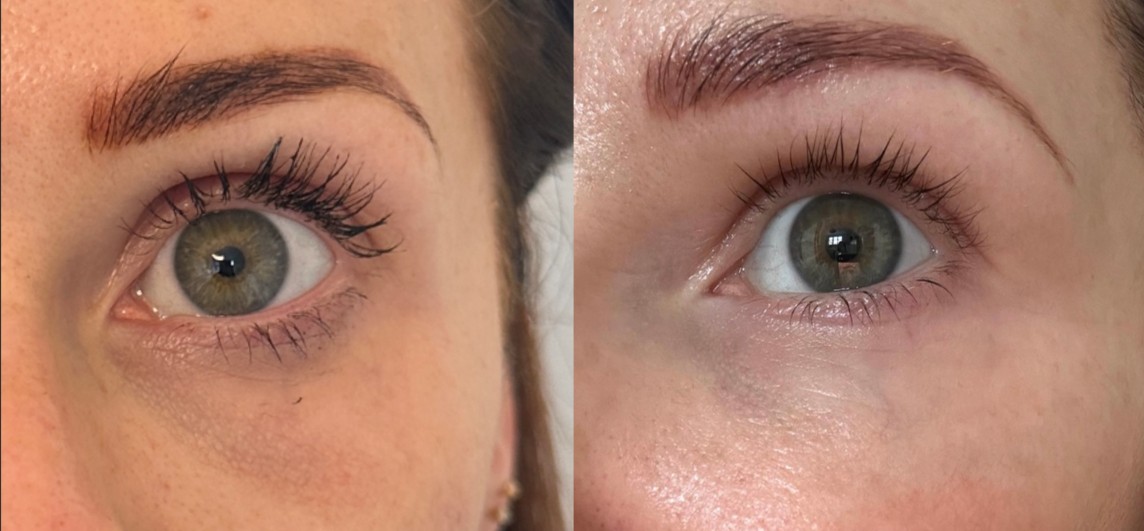 Jalupro Young Eye before and after result