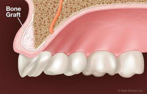 bone-graft