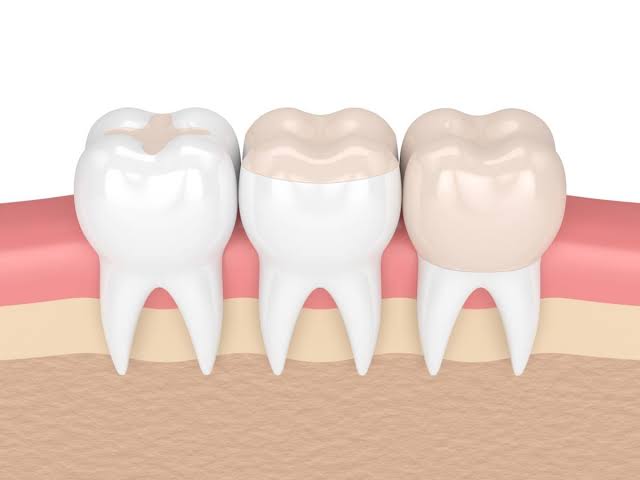 composite bonding fillings
