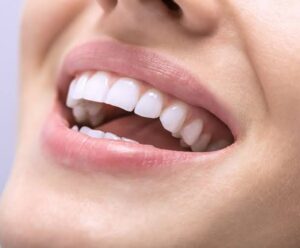 composite bonding fillings forest hill