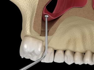 Sinus Lift Before Dental Implants